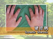 硬皮病