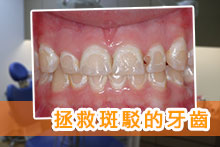 拯救斑駁的牙齒