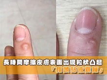 指頭黏液囊腫 [ Digital Mucous Cyst ]
