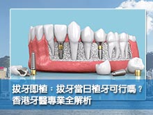 拔牙即植：拔牙當日植牙可行嗎？香港牙醫專業全解析