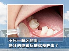 不只一顆牙的事：缺牙的連鎖反應你預咗未？