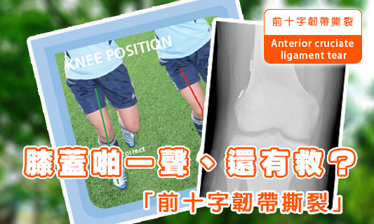 膝蓋啪一聲、還有救？
「前十字韌帶撕裂」