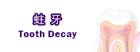 蛀牙 - Tooth Decay