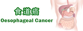 食道癌 - Oesophageal Cancer