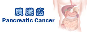 胰臟癌 - Pancreatic Cancer