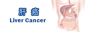 肝癌 - Liver Cancer