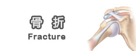 骨折[Fracture]