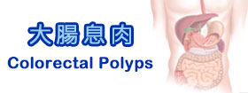 大腸息肉 - Colorectal Polyps
