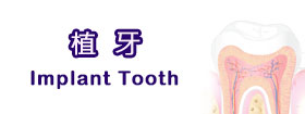 植牙 - Implant Tooth