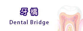 牙橋 - Dental Bridge