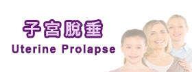 子宮脫垂 - Uterine Prolapse