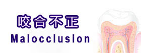 咬合不正 - Malocclusion