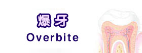 爆牙 - Overbite