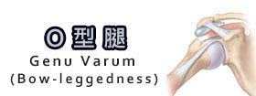 O型腿 - Bow-leggedness