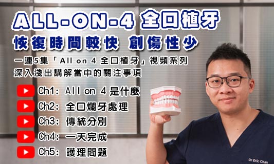 All-On-4 全口植牙重建